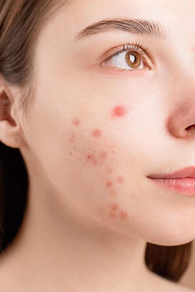 Alimentos que ajudam a eliminar acne do rosto